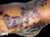 angiokeratoma circumscriptum