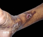 angiokeratoma circumscriptum