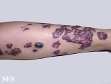 angiokeratoma circumscriptum