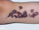 angiokeratoma circumscriptum