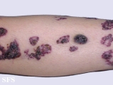 angiokeratoma circumscriptum