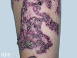 angiokeratoma circumscriptum