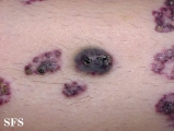 angiokeratoma circumscriptum