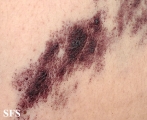angiokeratoma circumscriptum