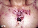 acne_fulminans