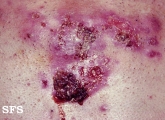 acne_fulminans