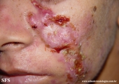 acne_fulminans