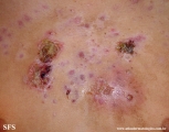 acne_fulminans