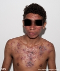 acne_fulminans