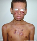 acne_fulminans