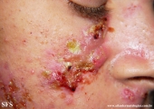 acne_fulminans