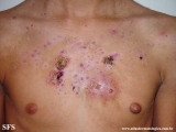 acne_fulminans