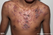 acne_fulminans