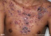 acne_fulminans