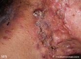 acne_fulminans
