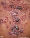 acne_fulminans