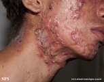acne_fulminans