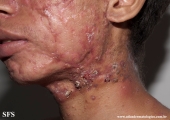 acne_fulminans