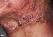 acne_fulminans