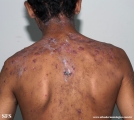 acne_fulminans