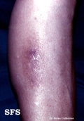 amyloidosis-macular amyloidosis