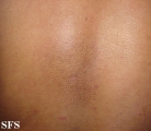 amyloidosis-macular amyloidosis