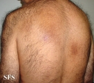 amyloidosis-macular amyloidosis