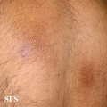 amyloidosis-macular amyloidosis