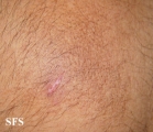 amyloidosis-macular amyloidosis