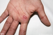 herpes simplex
