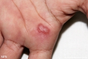 herpes simplex