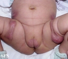 subcutaneous fat necrosis of the newbord