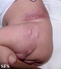 subcutaneous fat necrosis of the newbord
