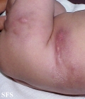 subcutaneous fat necrosis of the newbord