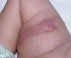 subcutaneous fat necrosis of the newbord