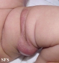 subcutaneous fat necrosis of the newbord