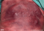subcutaneous fat necrosis of the newbord