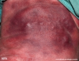 subcutaneous fat necrosis of the newbord