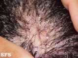 folliculitis decalvans
