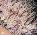folliculitis decalvans