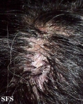 folliculitis decalvans