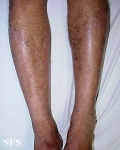 folliculitis decalvans