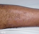 folliculitis decalvans