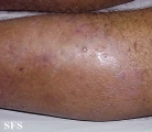 folliculitis decalvans