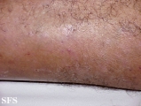 folliculitis decalvans
