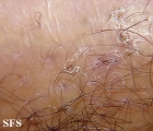 folliculitis decalvans