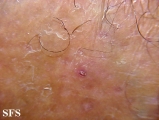 folliculitis decalvans