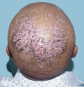 folliculitis decalvans