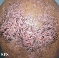 folliculitis decalvans