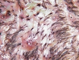 folliculitis decalvans